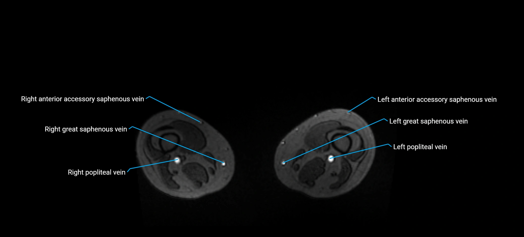 MRV abdomen pelvis & lower limb axial cross sectional anatomy labelled MRI image 331.webp